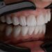 How to Stop Gum Bleeding Immediately (Home Remedies)