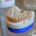 Gum Disease