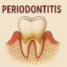 Periodontitis Treatment