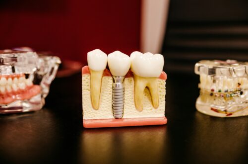 Teeth Problems